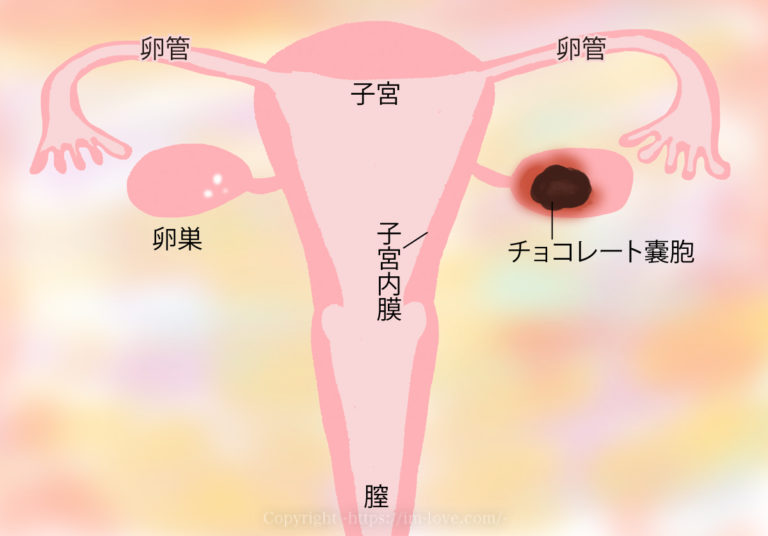 子宮内膜症（チョコレート嚢胞）を治して妊娠に導くための自然療法 I'M LOVE! 【あいむらぶ！】